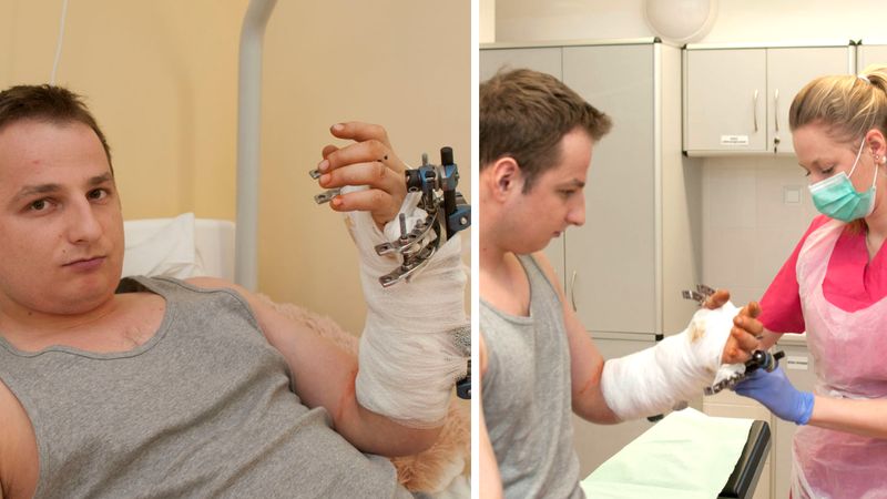 Lekarze chcieli amputować mężczyźnie rękę. Dopiero w trzecim szpitalu udało się ją przyszyć