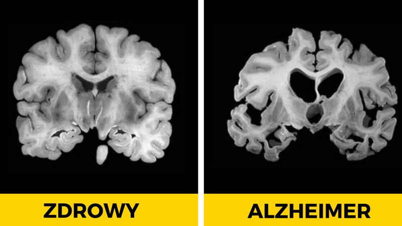 Wczesne objawy Alzheimera są bardzo wyraźne! Naucz się je rozpoznawać