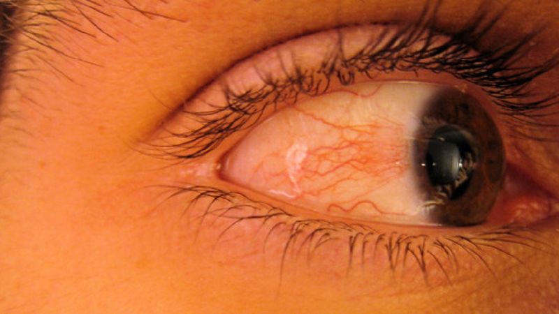 Łzawiące, zaczerwienione oczy objawem zakażenia COVID-19? Zdania naukowców są podzielone