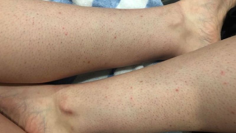 Truskawkowe nogi – problem, z którym zmaga się wiele kobiet. Jak sobie z nim radzić?