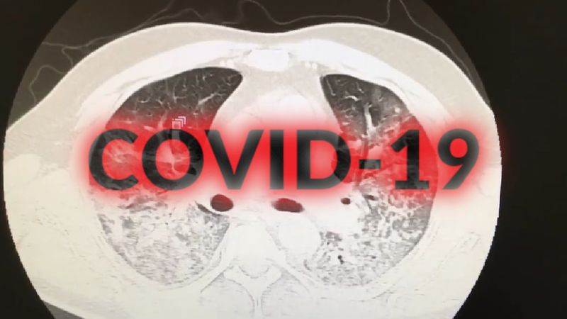 Co COVID-19 robi z płucami człowieka? Doktor omówił to na nagraniu