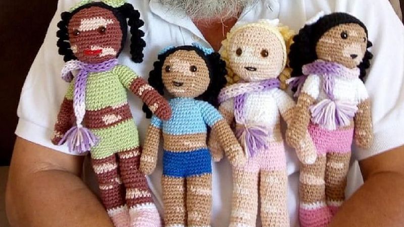Dziadek z bielactwem robi na drutach lalki, aby przywrócić poczucie własnej wartości dzieciom z bielactwem