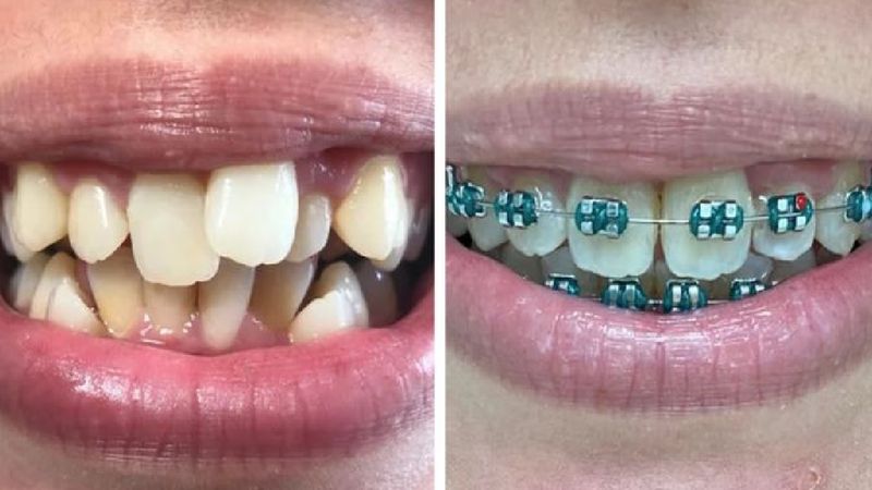 16 zdjęć, które dowodzą, że aparat na zęby czyni cuda. Ich uśmiechy są tego najlepszym dowodem