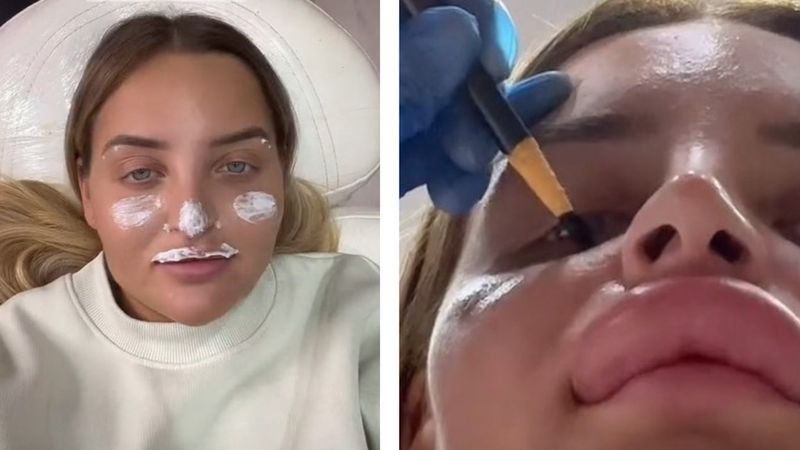 23-latka usunęła wypełniacz z ust. Efekt ją przeraził