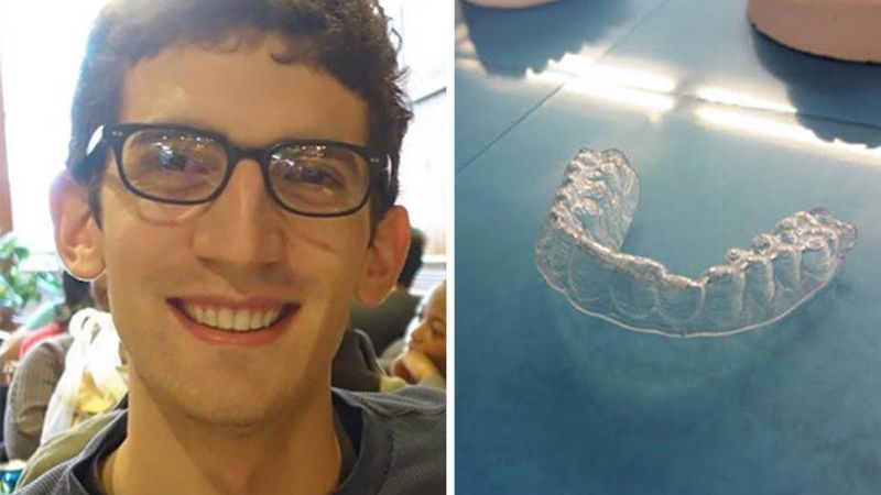 Student wydrukował w 3D swój własny aparat na zęby. Zaoszczędził tysiące złotych!