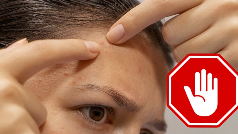 Dermatolog ostrzega, żebyś już nigdy więcej nie wyciskał pryszczy! Lepiej wypróbuj domowe sposoby