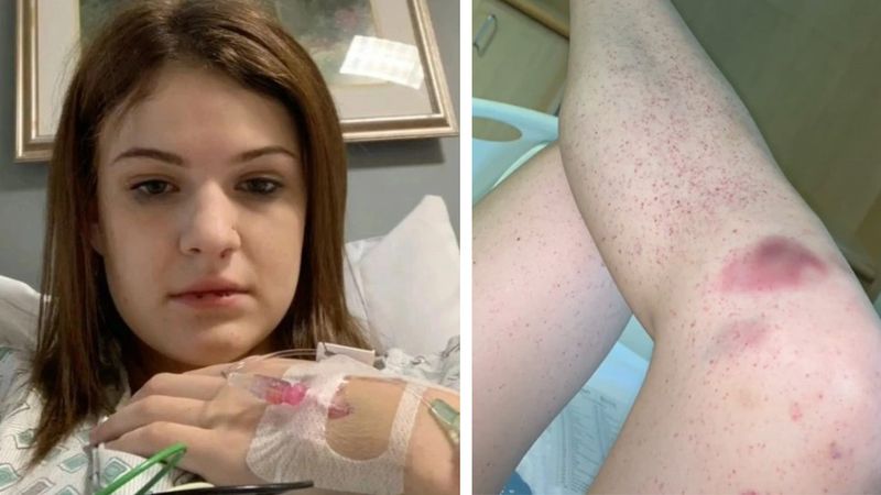 21-latka omal nie umarła przez wysypkę. Okazało się, że był to objaw rzadkiej choroby