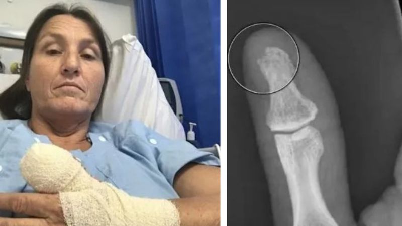Kobieta mogła stracić kciuka, po tym jak stylistka paznokci popełniła potworny błąd