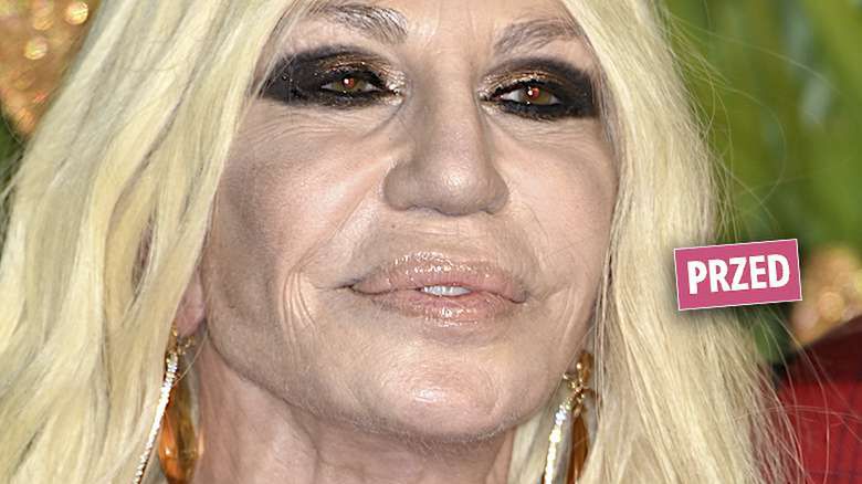 Donatella Versace „zmieniła” twarz! Po operacji odmłodniała o 20 lat! Cały świat zachwyca się tym, jak cudnie wygląda!