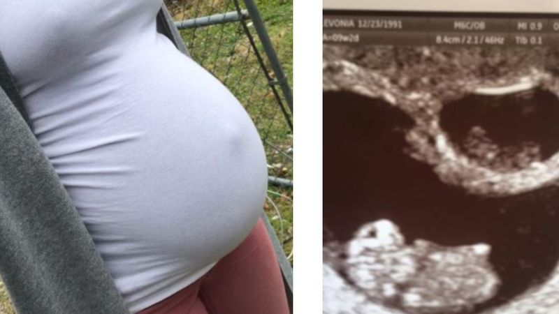 Była w ciąży z bliźniętami. Niestety jeden z maluszków „zniknął” z jej brzucha