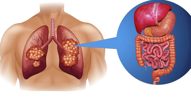 W nowotworze płuc natrafiono na miniaturowy układ trawienny. Naukowcy są wstrząśnięci odkryciem