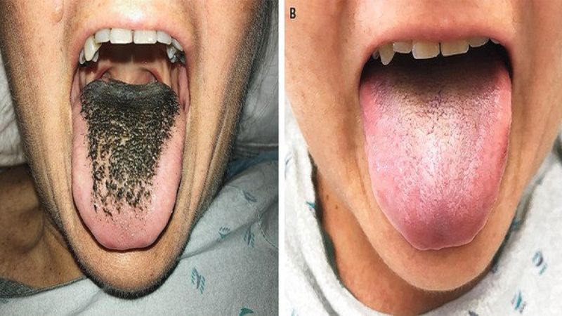 Czarny język włochaty to dolegliwość, której nabawiła się jedna z pacjentek po zażyciu antybiotyków