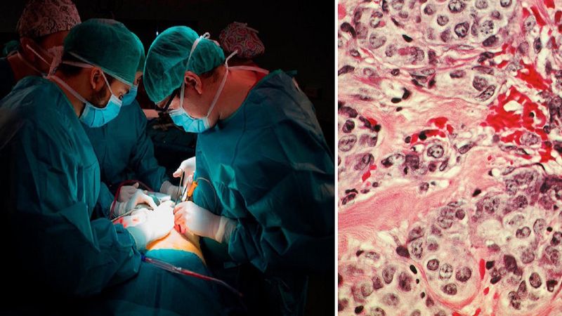 Cztery osoby zostały „zarażone” rakiem podczas przeszczepu organów pochodzących od jednego dawcy