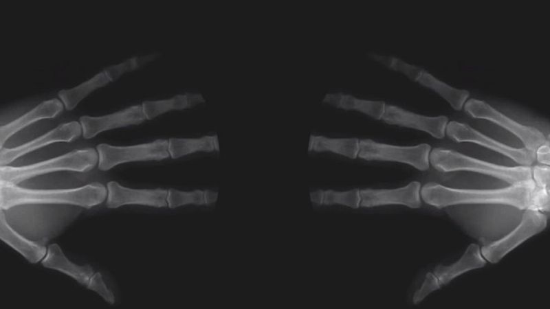 Przez 50 lat „strzelał” palcami jednej ręki. Badania ujawniły jakie ma to konsekwencje dla stawów