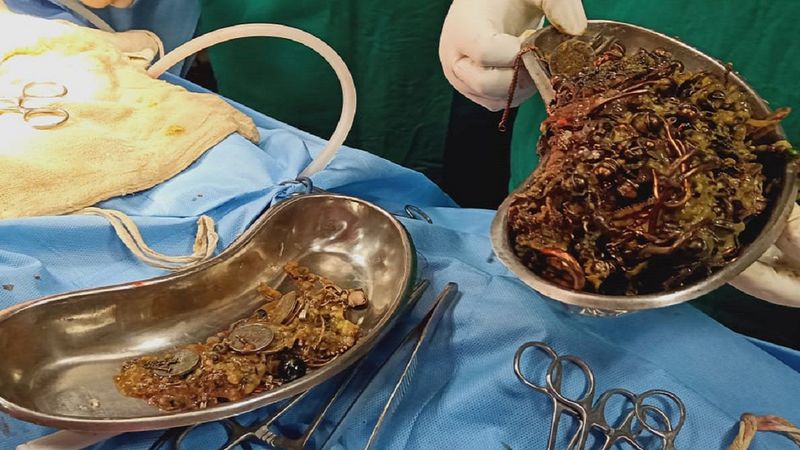 Zdumieni chirurdzy wyjęli 1,6 kilograma złotej biżuterii z żołądka 22-letniej pacjentki