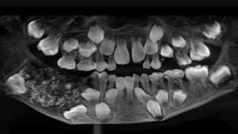 Chirurdzy w Indiach usunęli 526 zębów z jamy ustnej 7-letniego chłopca