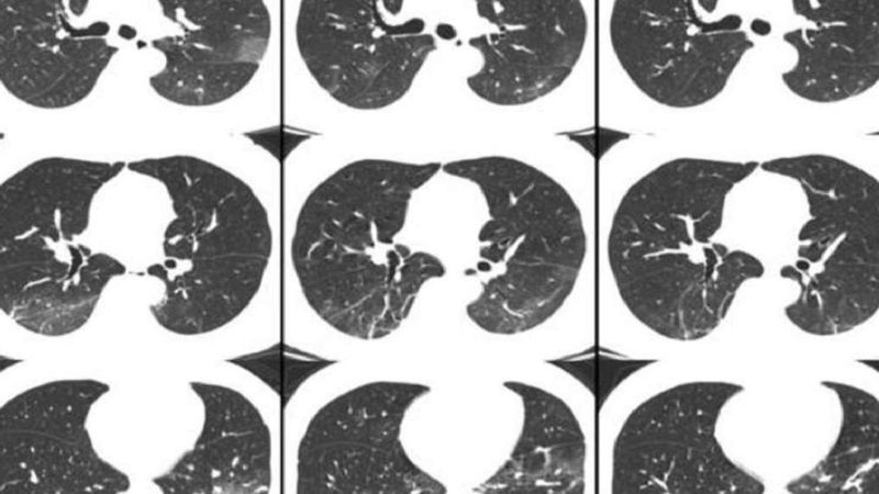 Skany tomografii komputerowej ujawniają, jak COVID-19 atakuje płuca zainfekowanych