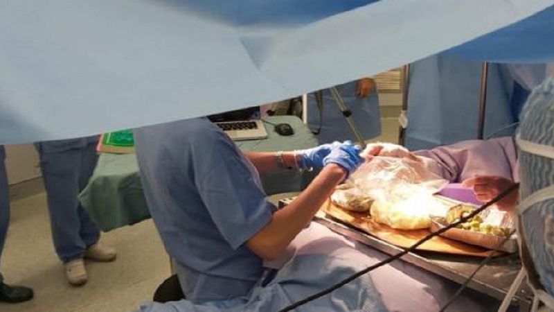 Włoszka przygotowała 90 nadziewanych oliwek podczas zabiegu wykonywanym na otwartej czaszce