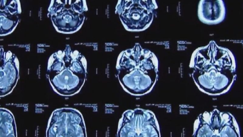 Wielu pacjentów z COVID-19 doświadcza problemów neurologicznych, ujawniają skany mózgu