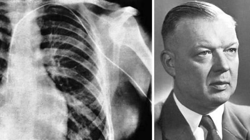 Werner Forssmann, pionier kardiologii, który otrzymał Nobla za wepchnięcie sobie rurki do serca