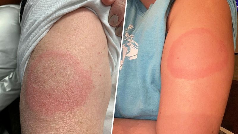 Covidowe ramię, czyli jak radzić sobie z opóźnioną reakcją alergiczną po szczepieniu