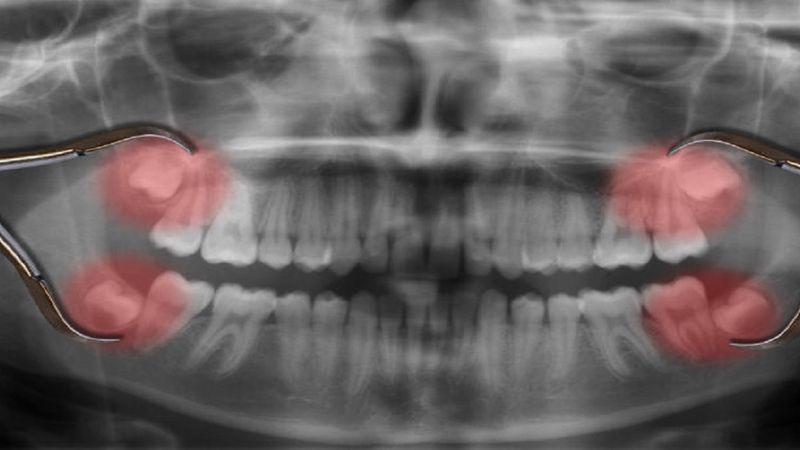Naukowcy w końcu odkryli dlaczego zęby mądrości pojawiają się w tak późnym wieku