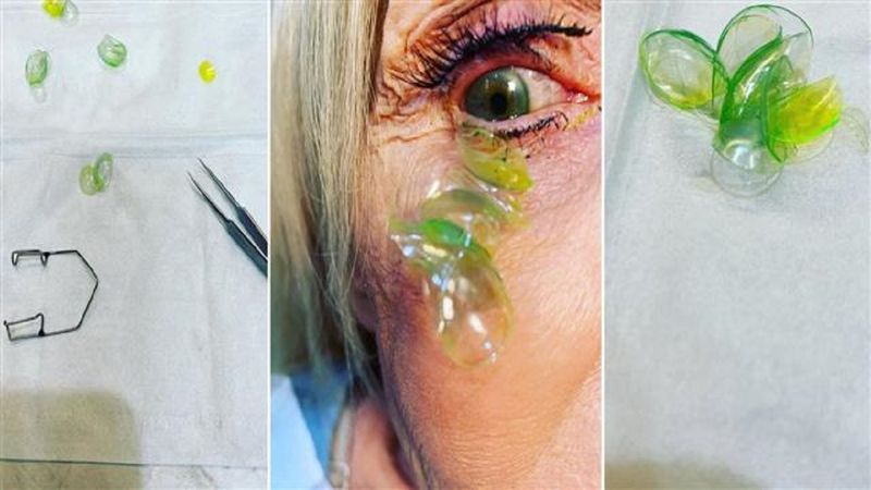 Kobieta zgłosiła się do optometrysty. W jej oku znajdowało się 23 „zaginione” soczewki
