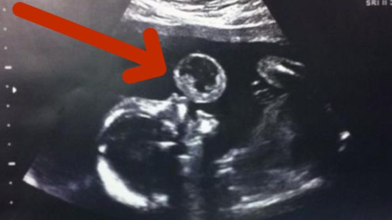USG pokazało, że dziecko, będące w brzuchu ma przy ustach dziwną „bańkę”. Lekarze rozkładali ręce