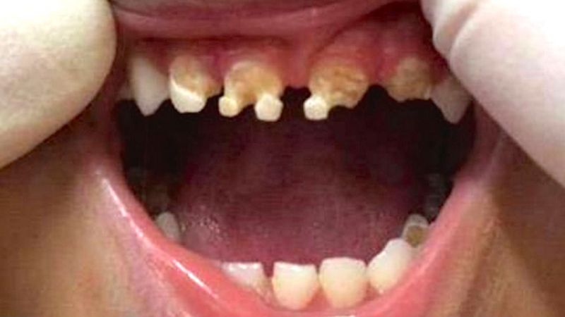 Dentysta zajrzał do buzi 3-latka i przeżył szok! Od razu zapytał jego mamę czy pozwalała mu pić…?