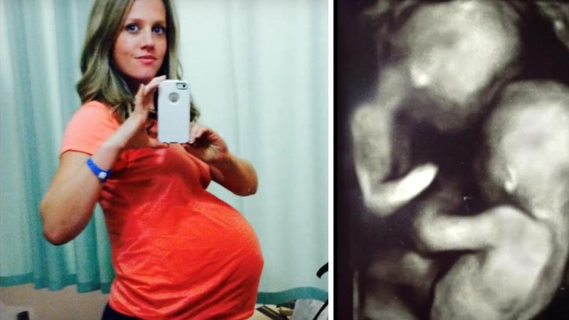 Ta kobieta była w ciąży z bliźniakami. Na jednym z ostatnich USG lekarz zobaczył coś niepokojącego