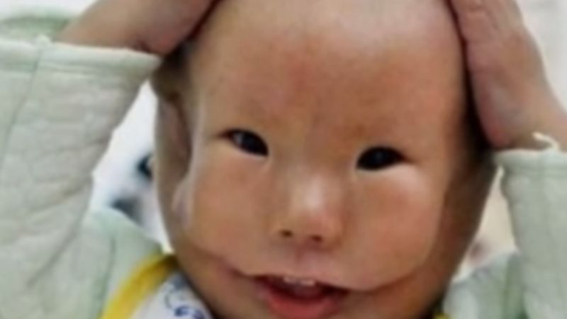 W Chinach urodził się chłopiec z podwójną twarzą. Lekarze chcę przeprowadzić poważną operację, aby poprawić jego wygląd