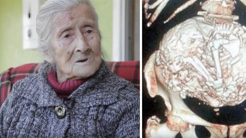 Lekarz odkrył w brzuchu 60-letniej kobiety guza. Jak się okazało było to jej nienarodzone dziecko