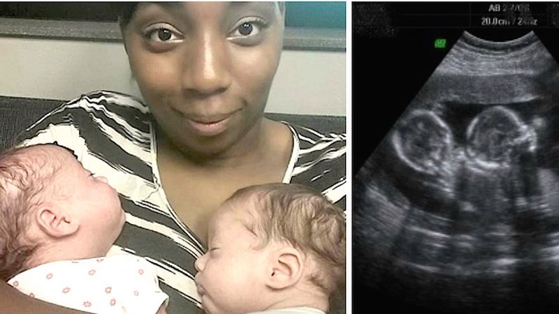 W ciągu zaledwie 2 lat, ta kobieta zaszła 3 razy w ciążę bliźniaczą! Sami lekarze są w szoku