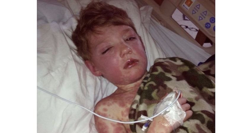 Mały chłopiec przeżył śmiertelną chorobę skóry, która została wywołana przez środki przeciwbólowe