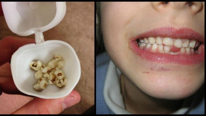 Lekarze apelują, aby nie wyrzucać zębów mlecznych dzieci. Mogą później uratować życie
