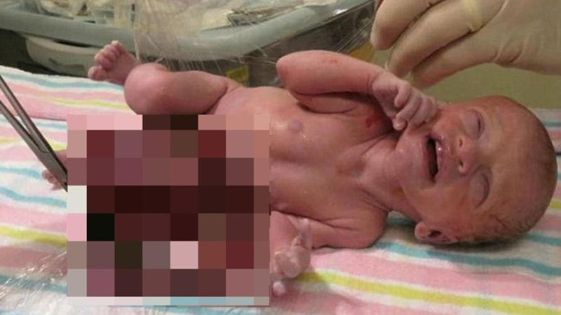 Lekarz zasugerował matce usunięcie ciąży, ponieważ jego zdaniem dziecku nie można było pomóc
