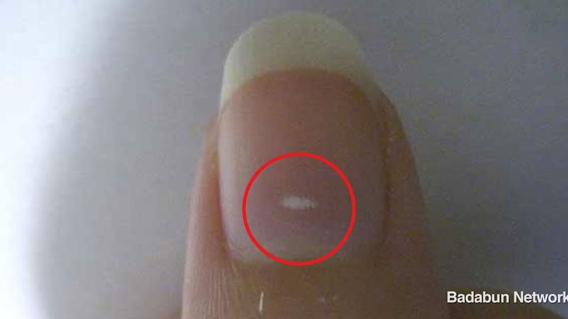 Zauważyłaś u siebie białe plamy na paznokciach? Zobacz co może być przyczyną