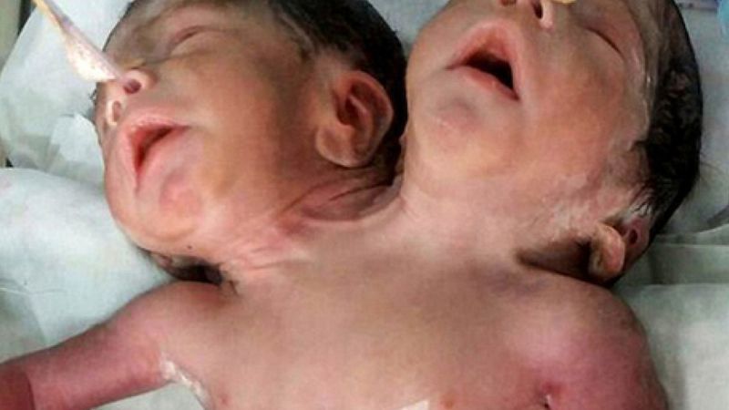 Zaledwie 32 godziny po porodzie matka zabrała te bliźnięta syjamskie do domu. Wtedy stało się najgorsze