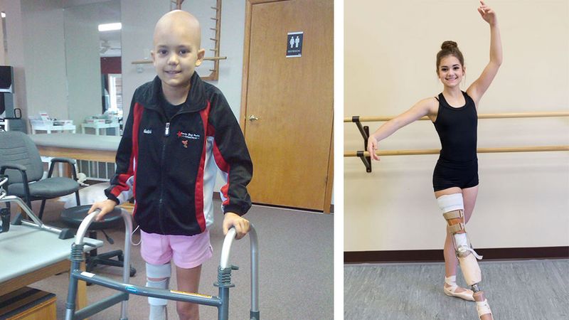 15-letnia baletnica straciła nogę z powodu nowotworu. To nie przeszkodziło jej w realizacji marzeń