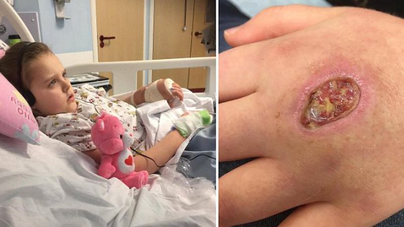 8-latka trafiła do szpitala z dziurą w dłoni. Nikt nie przypuszczał, co zaatakowało dziewczynkę