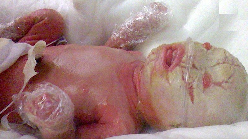 Dziecko rodzi się pokryte grubymi, białymi płatami skóry. 5 lat później wygląda zupełnie inaczej…