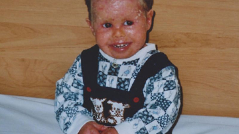 Ten chłopiec cierpi na ekstremalnie rzadką chorobę skóry. W leczeniu pomaga mu 300 małych stworzeń