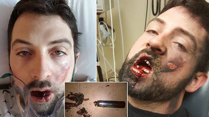 30-latek stracił 7 zębów i doznał silnych poparzeń, po tym jak e-papieros wybuchł mu w ustach!
