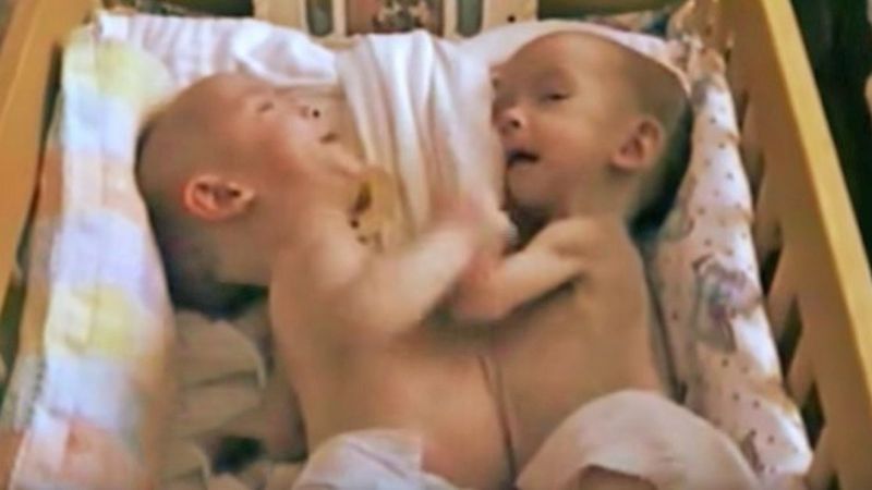 Mama rodzi bliźnięta syjamskie i nie wie, czy przeżyją. 18 lat później są nie do poznania