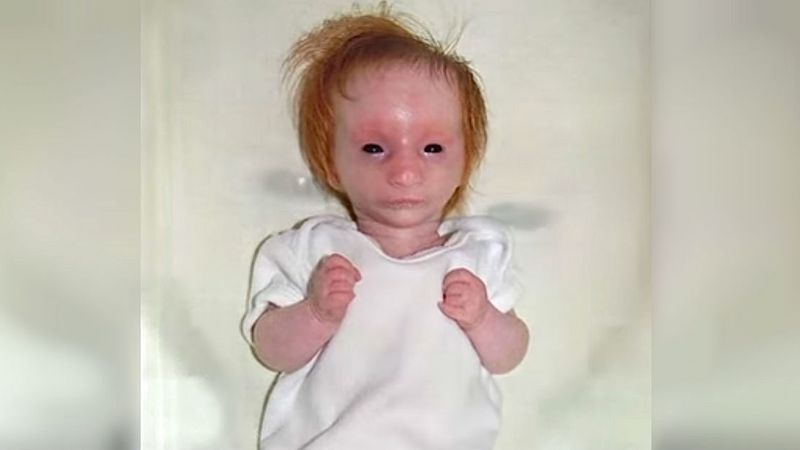 Kiedy się urodziła, wyglądała jak porcelanowa lalka. Mając 5 lat, dziewczynka nie ważyła nawet 5 kg