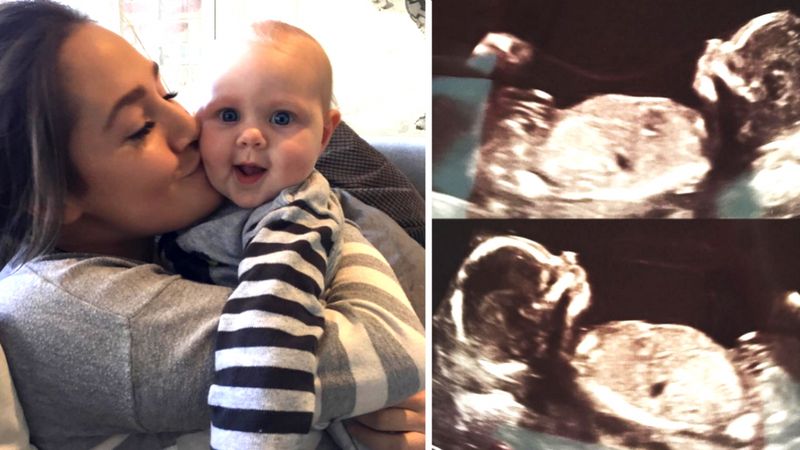 Kobieta urodziła dziecko. 6 tygodni później, lekarz informuje ją, że jest w ciąży bliźniaczej!