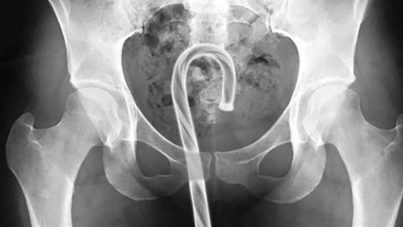31 najdziwniejszych zdjęć rentgenowskich. Niewiarygodne co ci ludzie mieli w swoich ciałach!