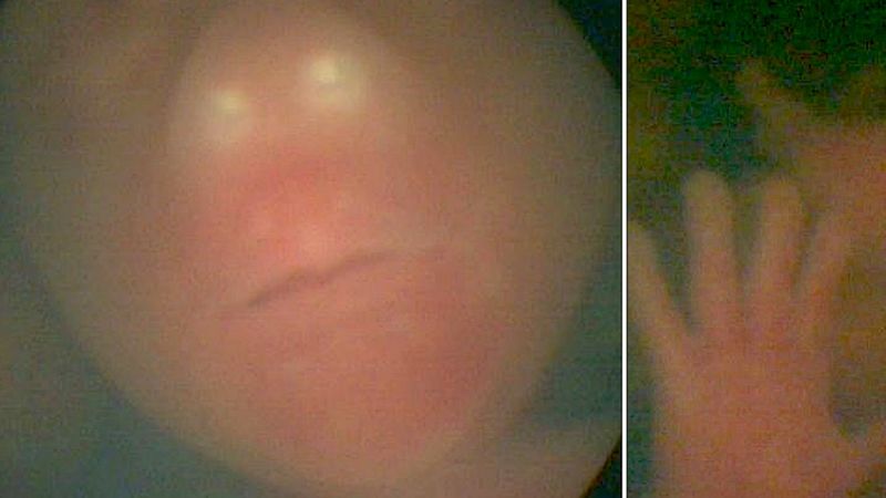 Mama oczekiwała jednojajowych bliźniąt. W czasie badań na jaw wyszła zagrażająca ciąży prawda