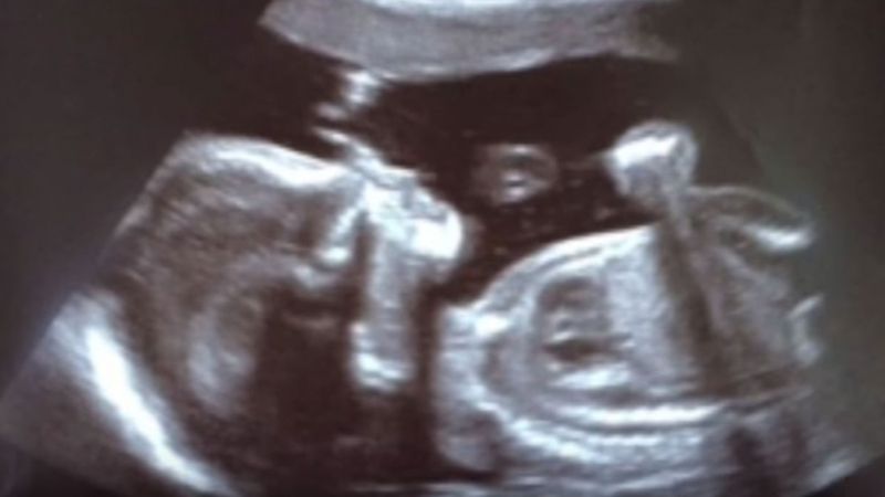Podczas badania USG widać białą poświatę wokół główki dziecka. Gdy się rodzi, mówi o niej cały szpital!