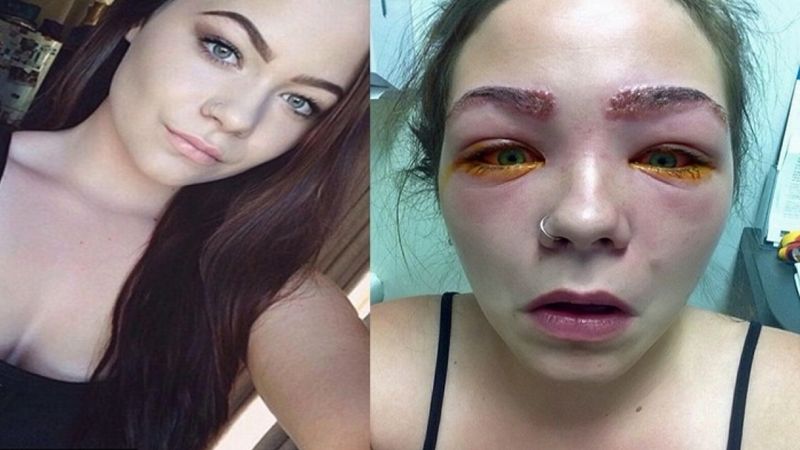 16-latka prawie straciła wzrok. Wszystko z powodu kosmetyku, którego używa większość kobiet!